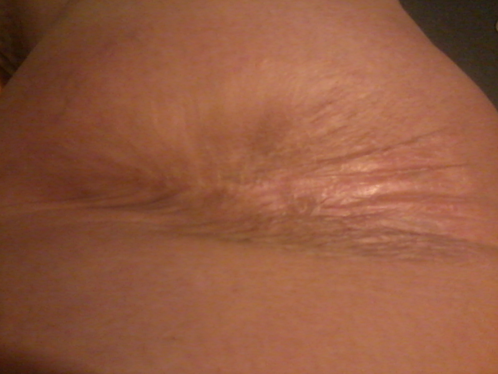 This is the scar I have on my right leg as a result of two operations.